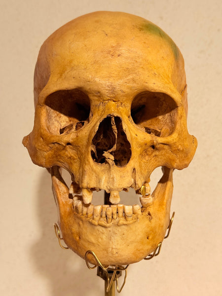 Originalt antikt menneske kranie, med 18K guldtand og udstillingsstativ. (Cranium homo sapiens)