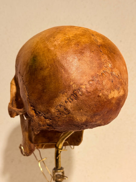 Originalt antikt menneske kranie, med 18K guldtand og udstillingsstativ. (Cranium homo sapiens)