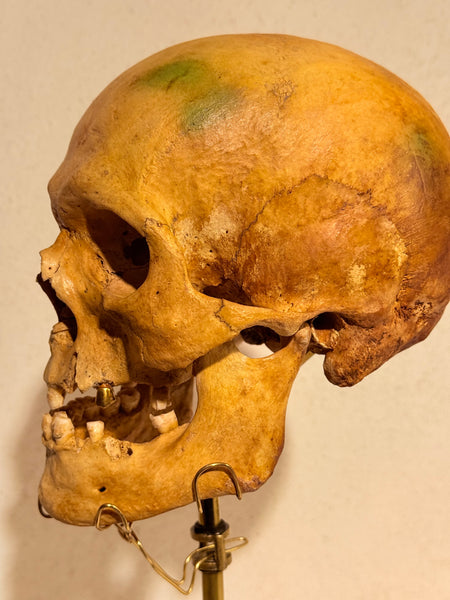 Originalt antikt menneske kranie, med 18K guldtand og udstillingsstativ. (Cranium homo sapiens)