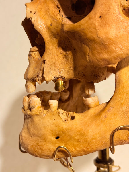 Originalt antikt menneske kranie, med 18K guldtand og udstillingsstativ. (Cranium homo sapiens)
