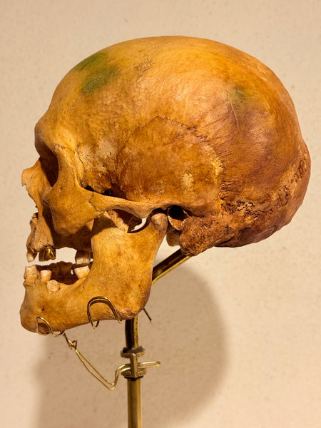 Originalt antikt menneske kranie, med 18K guldtand og udstillingsstativ. (Cranium homo sapiens)