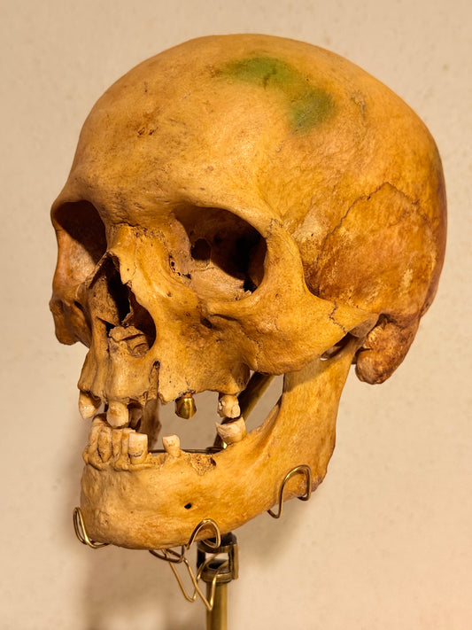 Originalt antikt menneske kranie, med 18K guldtand og udstillingsstativ. (Cranium homo sapiens)
