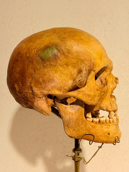 Originalt antikt menneske kranie, med 18K guldtand og udstillingsstativ. (Cranium homo sapiens)